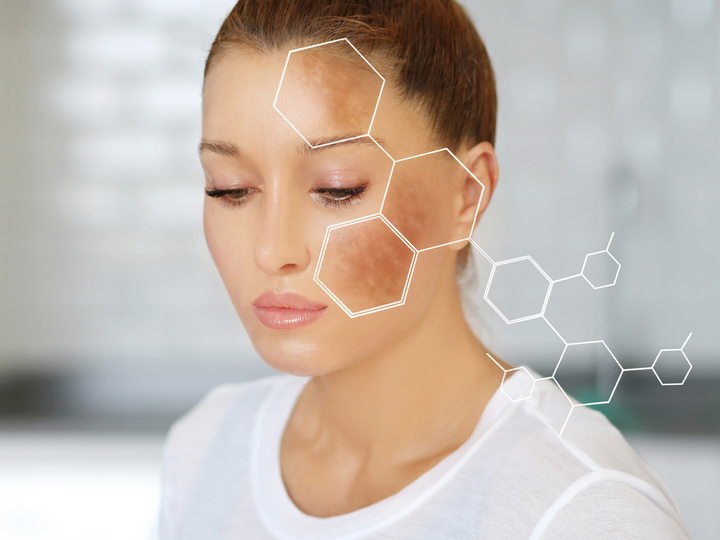 Lady with hyperpigmentation or melasma on her face to show Heliocare and Fernblock activity to repair and prevent hyperpigmentation and melasma
